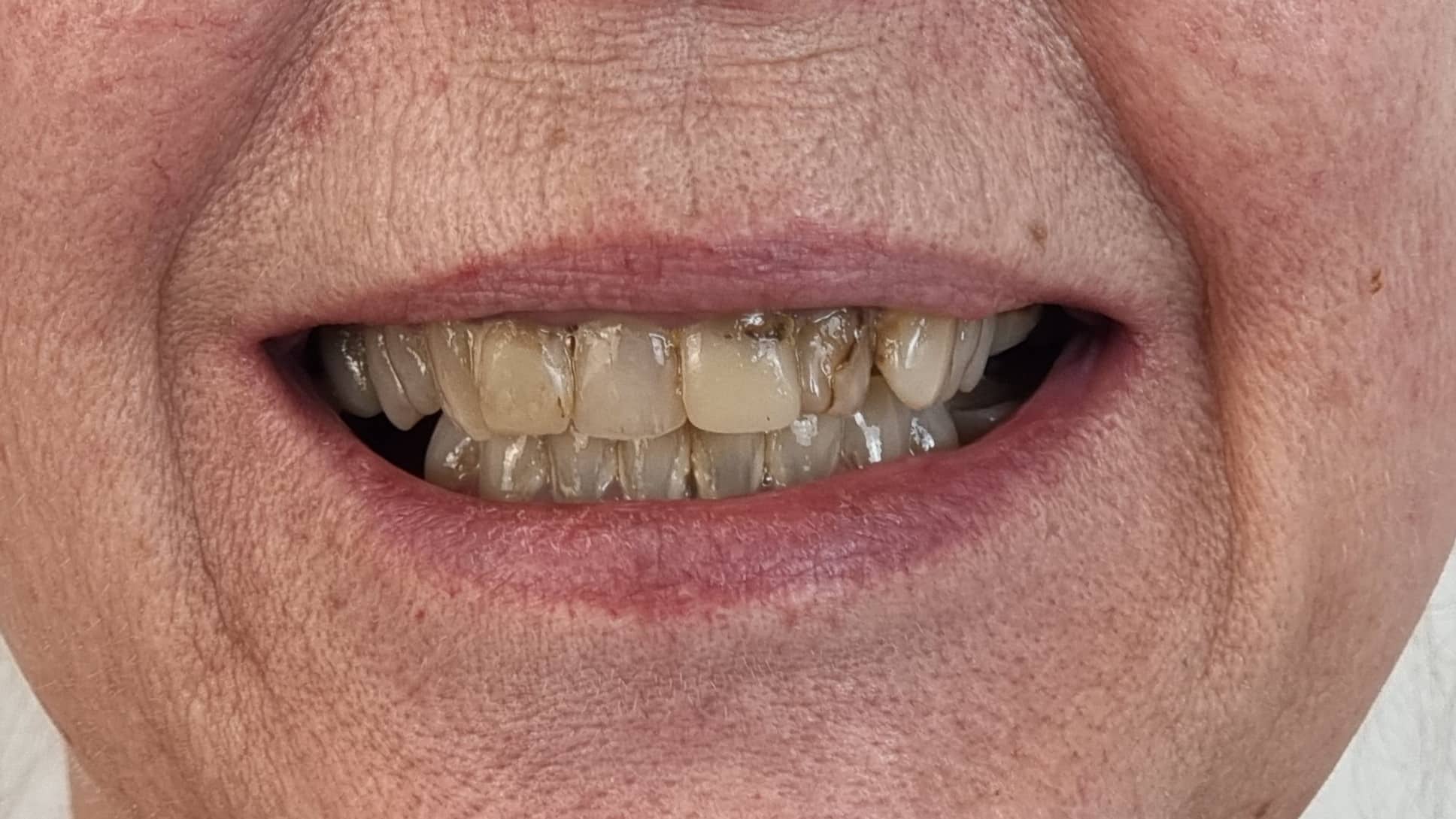 Before Veneers